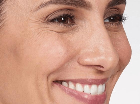 42yr old female Botox After